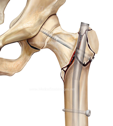 Hip Intertrochanteric Fracture Repair
