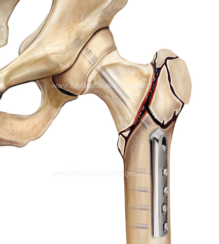 Hip Compression Screw Fixture of an Intertrochanteric Fracture