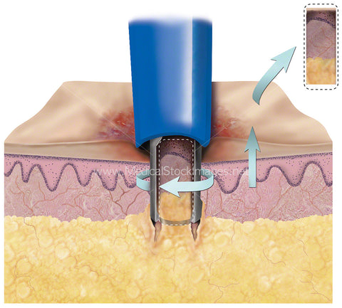 Punch Biopsy Taking Skin Sample