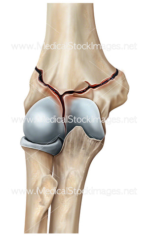 Elbow Fracture Posterior View