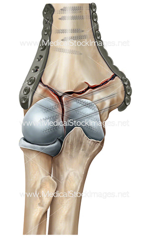 Elbow Fracture Repair