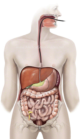 Procedure to Insert Tube into Stomach