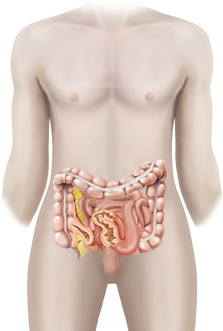 Crohn's Disease