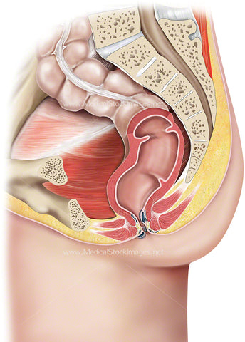 Anal Haemorrhoids in Rectum