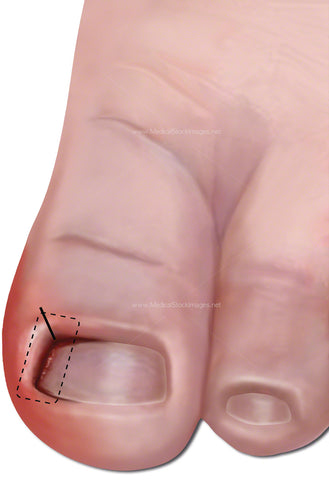 Ingrowing Toe Nail Rectified with Wedge Incision (Child)