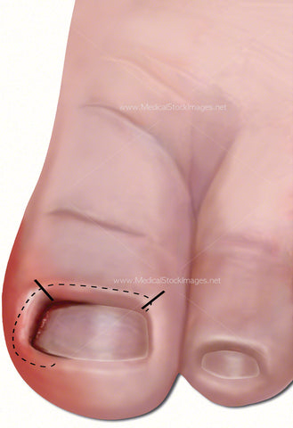 Ingrowing Toe Nail Rectified with Zadek’s Incision (Child)