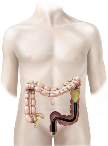 Large Bowel with a Colonoscope (Adolescent)