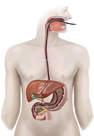 Endoscopic Procedure