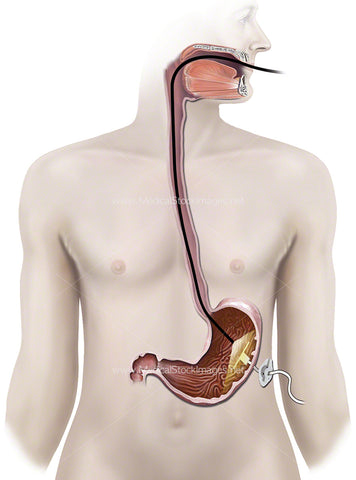 Endoscopy Procedure (Adult)