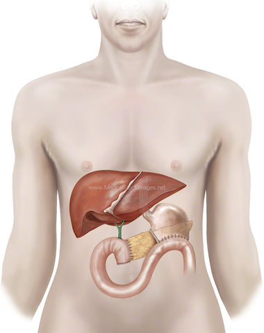 Gallbladder Removal by Laparoscopic Cholecystectomy