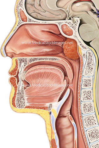 Enlarged Adenoid