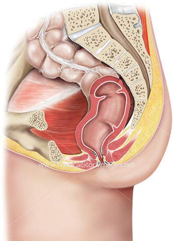 Anal Fissure in Rectum