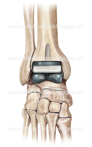 Ankle Replacement Surgery