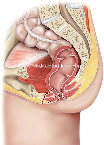 Anal Fistula