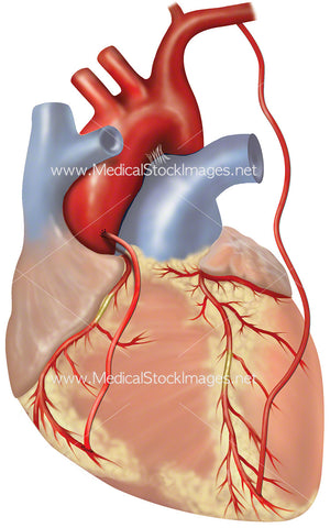 Coronary Artery Bypass