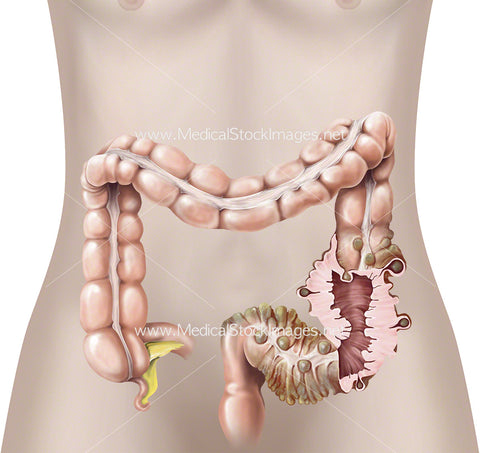 Diverticular Large Bowel