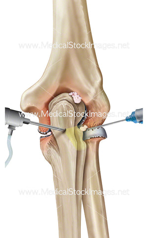 Elbow Arthroscopy