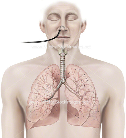 Endobronchial Ultrasound Bronchoscopy (EBUS)