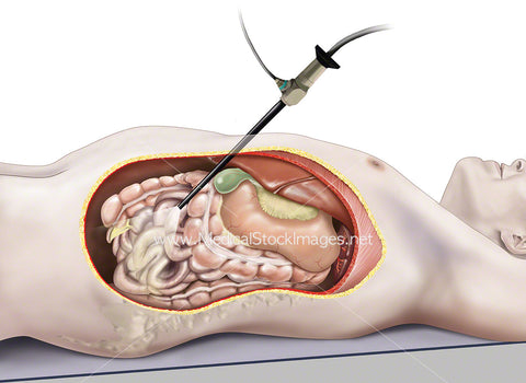 Laparoscopic Surgery Procedure