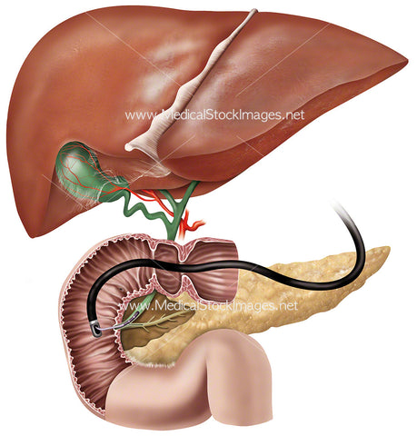 Endoscopic Retrograde