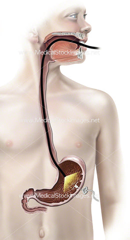 Endoscopy in Adolescent with Port