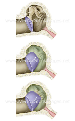 Tympanic Membrane Retraction Stages (Middle Ear Atelectasis)