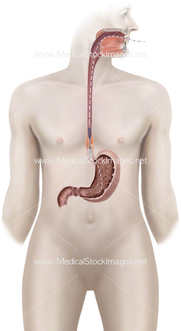 Oesophagus Tumour with a Stent Placement