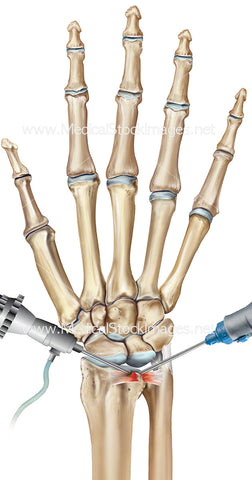 Wrist Triangular Fibro Cartilage Repair