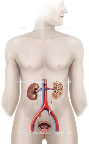 Ureter Kidney Stone