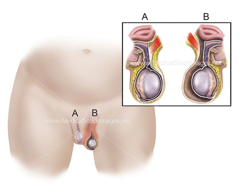 Testicle Hydrocele in an Infant