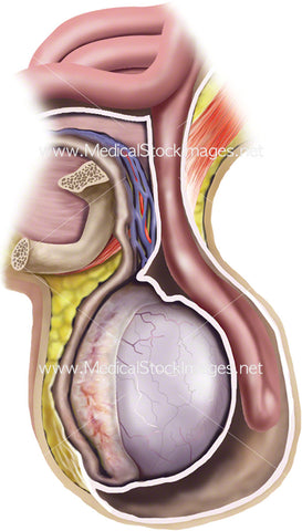 Testicular Compromise Due to Inguinal Hernia