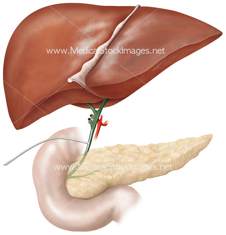 T-Tube Common Bile Duct