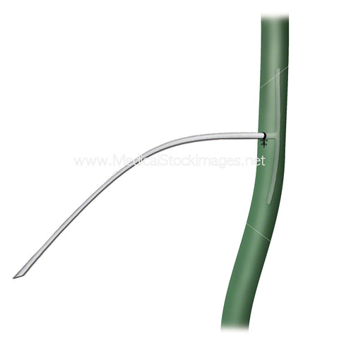 T-Tube used in Gallbladder Surgery