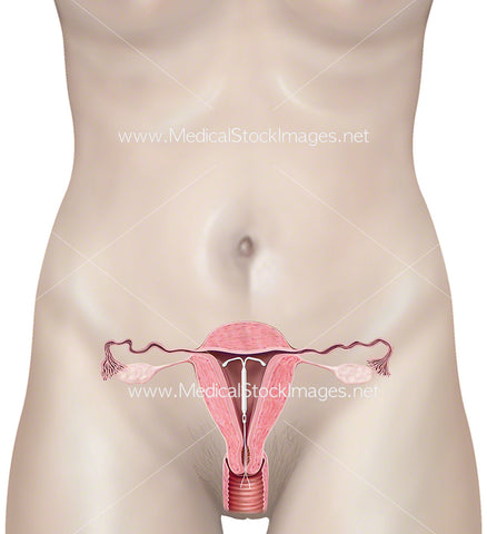Female Uterus with an IUD