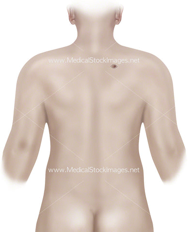 Subcutaneous Lump