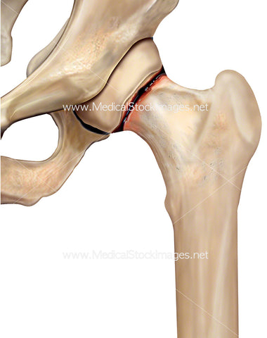 Hip Subcapital Fracture