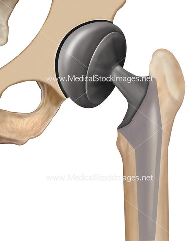 Hip Partial Replacement