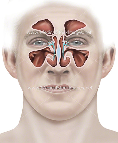 Temporary Plant (Sinuses)