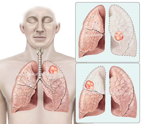 Varying Locations of Tumour on the Lungs