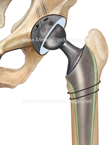 Revision Total Hip Replacement