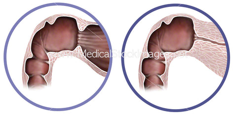 Pyloric Stenosis