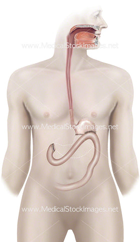 Partial Gastectomy