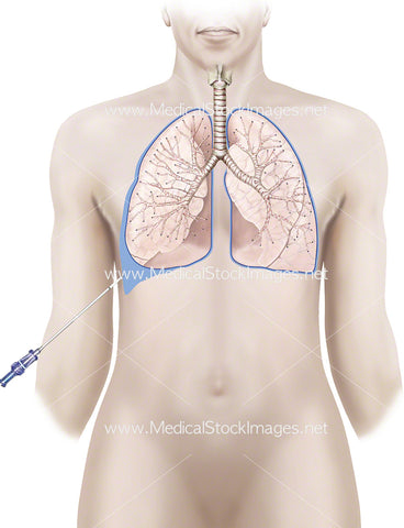 Pleural Biopsy of the Lung