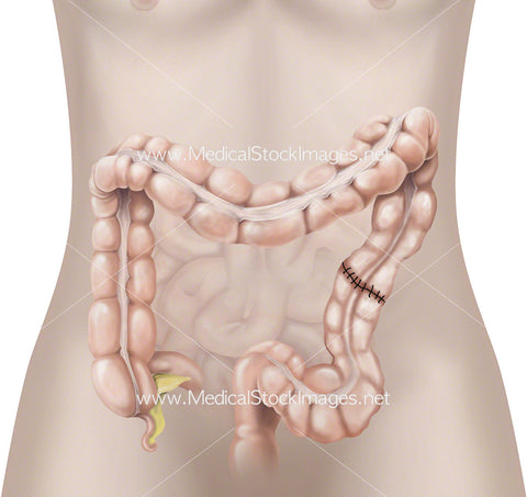 Surgical Closing after a Colostomy Procedure.