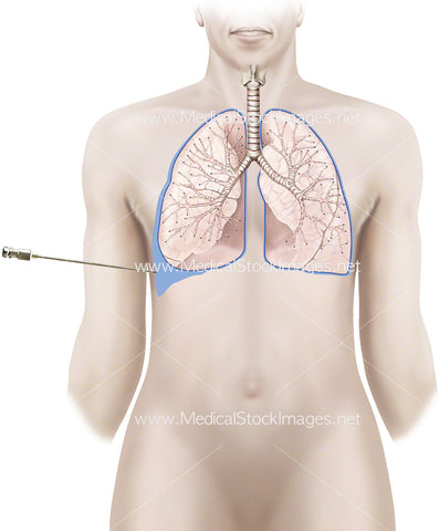 Pleural Biopsy with Needle in Place