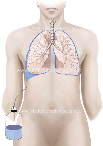 Chest Drain in Pleural Space