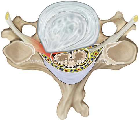 Compressed Root Cervical Disc