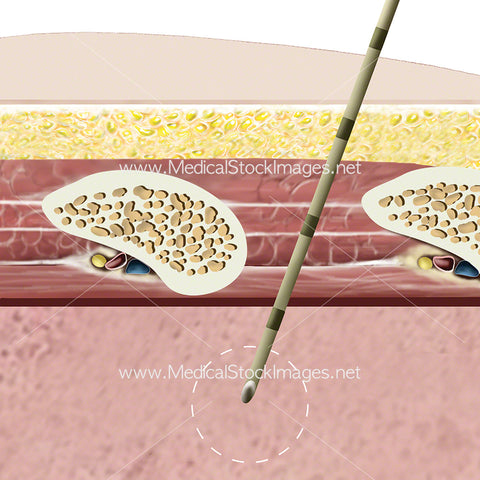 Close up View Biopsy Needle in Lung