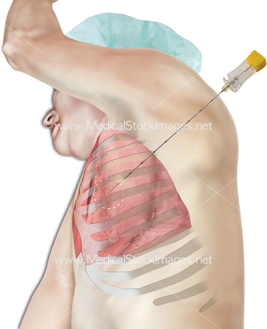 Biopsy Needle in Lung