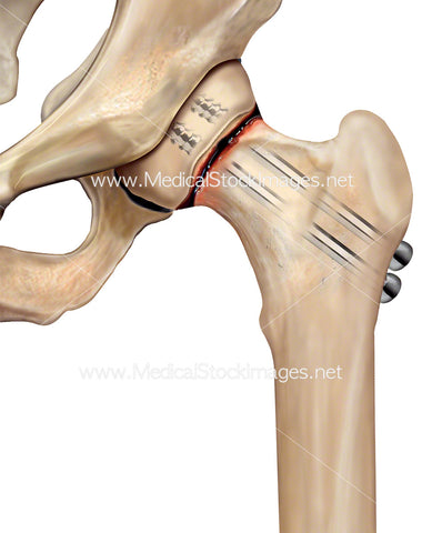 Subcapital Hip Facture Repair